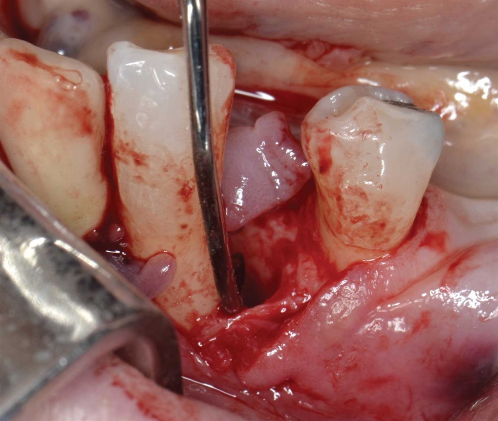 Tarquini_Periodontal intrabony defect